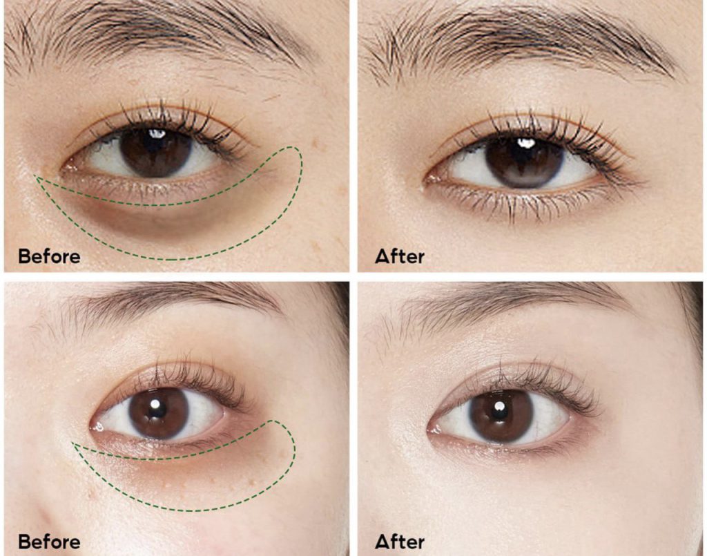 کرم دور چشم فیلورگا مدل Optim-Eyes 9 تاثیر استفاده از کرم دور چشم فیلورگا