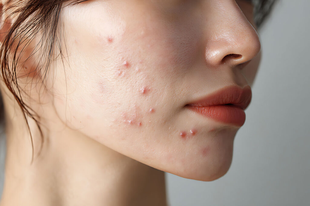از بین بردن جای جوش